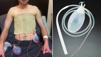 Дренаж Джексон-Пратта, JP дренаж: что это за процедура, причины, противопоказания, как делают, что после